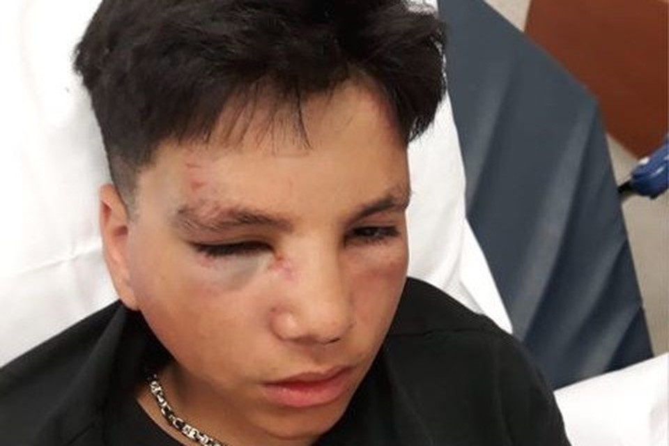 De oogkas en neus van Ouassim zijn gebroken en hij heeft blauwe plekken op zijn gezicht. 