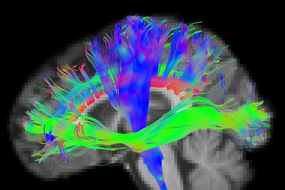 Met MRI-scans hebben de onderzoekers de verbindingen in de hersenen bij diabeten zichtbaar gemaakt.